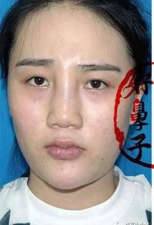 「好看」鼻子做成什么样才好看,一篇务实的鼻修复参考(三)|日本医美