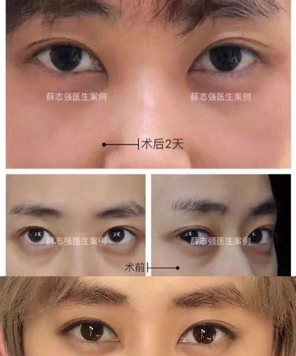  [熬夜]明明说好一起熬夜的，为什么就只有你熬出了眼袋+黑眼圈？