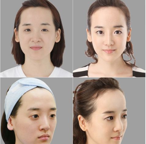 关于双眼皮的那些触目惊心的案例!