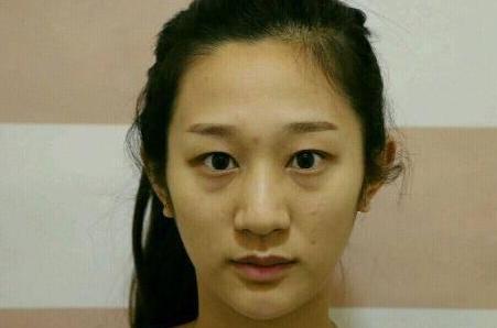 切开双眼皮真实案例分享，眼睛变大变有神了