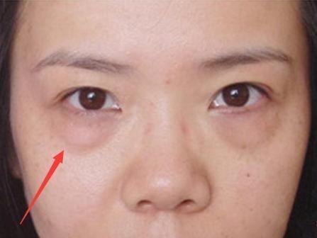 皮肤科教授透露:睡前抹点药店“白菜价乳膏，脂肪粒、眼袋去无影