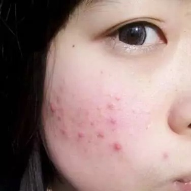 皮肤不会喊痛, 但如果出现这几个征兆, 说明脸上螨虫已经躲不住了