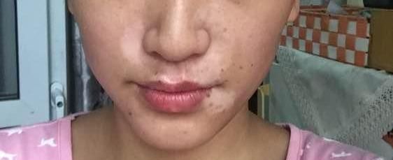 【刺痛】护肤和毁容中间就差一瓶磨砂膏?女孩护肤不成,反被白癜风爬上脸