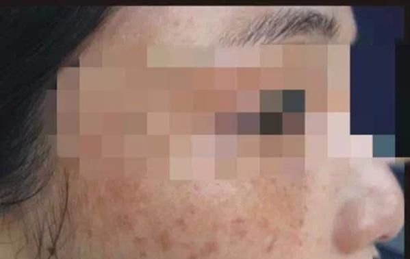  『炎症后黑色』不想长斑?教你1招,食用盐加它抹一抹,不出一月,斑点皱纹说拜拜!