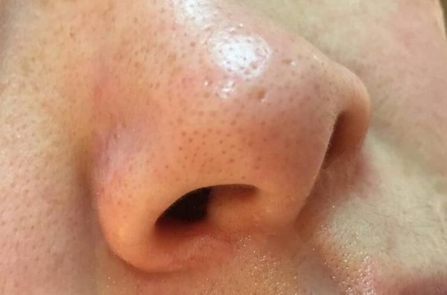 脸上螨虫成灾怎么办?用这一招，螨虫全都死光光