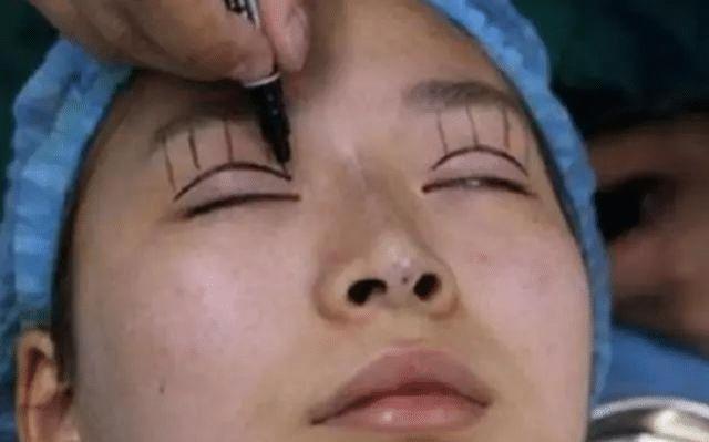 手术:做过双眼皮手术的年轻人,老了以后眼睛会怎么样看来是这个道理