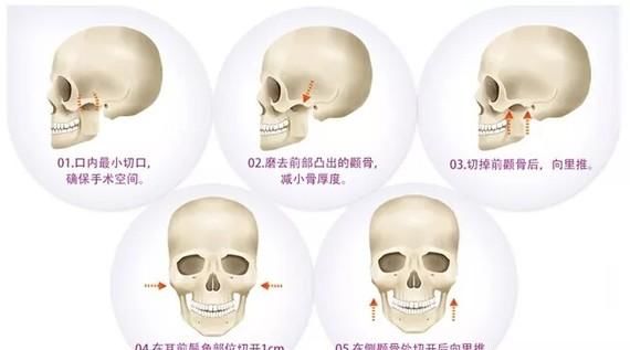  「颧弓」面部轮廓整形之“颧骨颧弓”