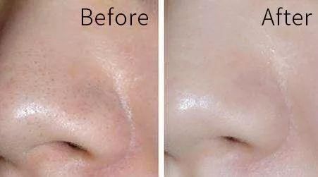 毛孔粗大至少显老10岁?怎样才能摆脱“孔肤人”称号