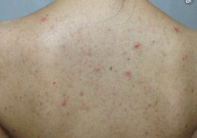 后背长痘还能扣下小米粒,准是螨虫来了,在后背像蚂蚁一样到处爬