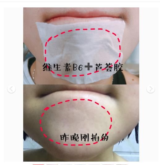 5块钱维生素B6 闭口、粉刺、痘痘统统消!好用到哭!
