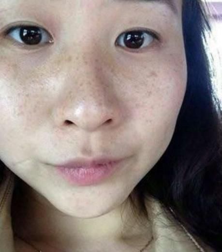 红霉素只要一支擦脸，学会用法，脸上斑点消失，皮肤光滑白嫩