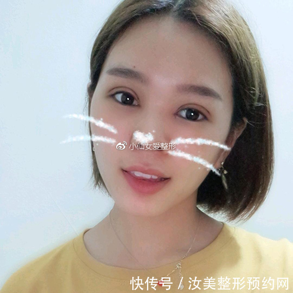 开内眼角前后对比照片，不灵不灵的大眼睛也着实的迷人