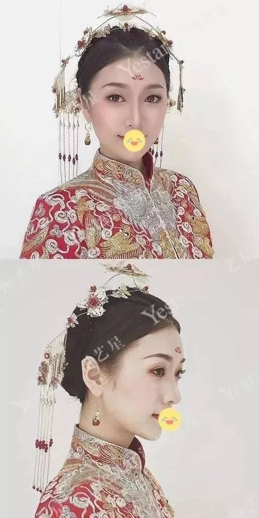  济南■「济南艺星双眼皮」别傻了！这种“无痕双眼皮”其实就是……