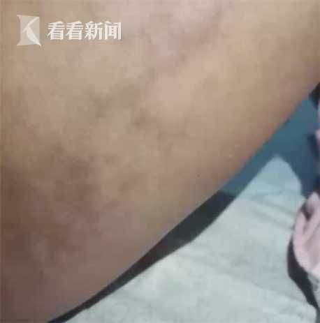  『整容』脸太瘦不够“旺夫”？女子花4万整容 结果成了这样