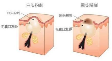 简单去黑头的5个小方法，让你彻底甩掉它!