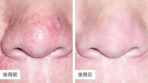  皮肤屏障@只有玻尿酸的补水效果才好？怕是忘了什么叫做“泛醇”