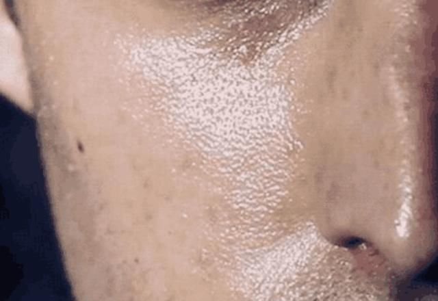 毛孔粗黑头多，示意螨虫“车载斗量”, 支配3妙招，一举歼灭螨虫