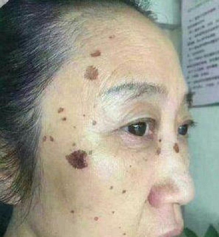长出“老年斑”别慌张，用了药店的“小药膏”斑不见了脸也变白了