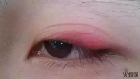 双眼皮贴的三大危害，你知道吗？