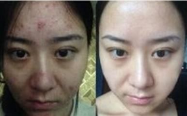 白醋祛斑真的能行吗?老中医一再提醒:斑点全部撵走完只需一瓶醋