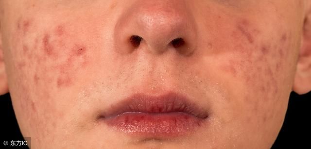 脸上发黄有痘痘？是螨虫在纠缠，每天需一法，螨虫轻松消失干净