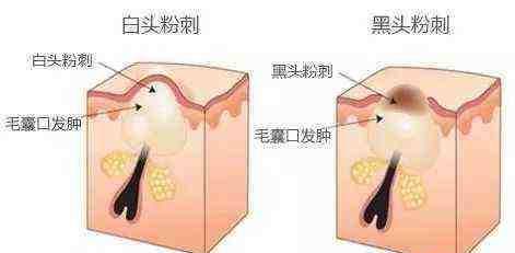  #作战#护肤大作战：你真的了解黑头吗？教你一招，和“草莓鼻”说拜拜！