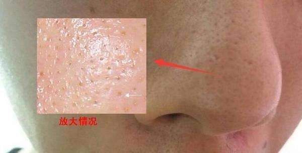 为何黑头总是反复去不掉? 用3招不撕不挤, 黑头粉刺“如雨落下”