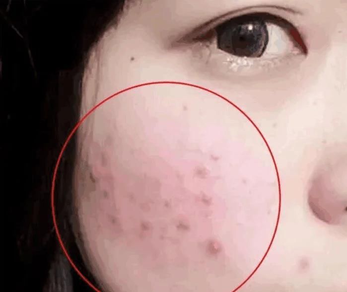  「脸上」螨虫号称“皮肤打孔机”, 毛孔粗大根源, 大家的脸上有螨虫吗!