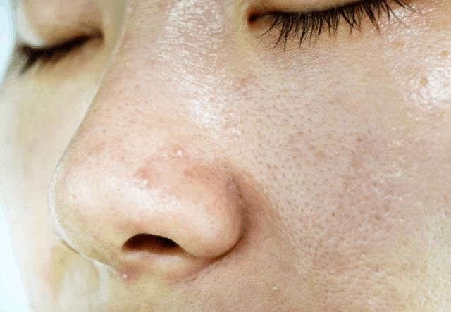 起床后有这3个问题的，说明是螨虫在毛孔里“工作”一整夜的成果