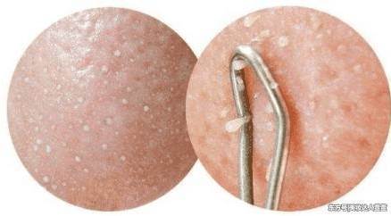 3个损害出现脸上,说明皮肤遭受螨虫摧残,只需用到2招可排空