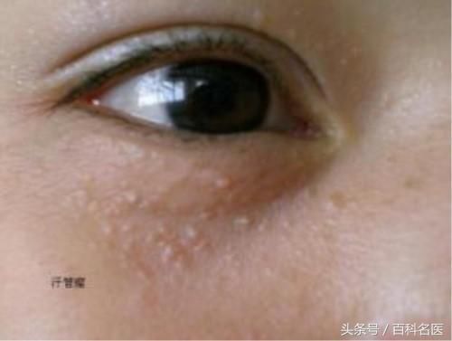 下巴紧绷后的白色颗粒到底是什么?