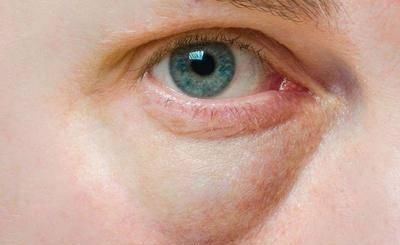  『皮肤』消除眼袋的方法找到了！按摩排第二，最后一个大家都得要做好