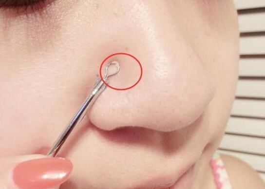 鼻头里的白条是螨虫吗？看这里，1眼辨别！