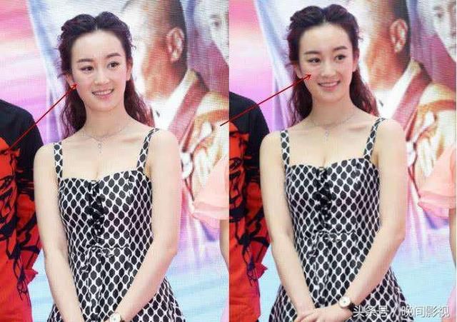 张檬取出假体后遗症严重，变成“风尘女子”！