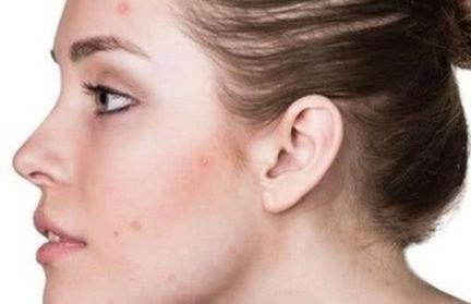 脸上毛孔被螨虫“堵住了”,会具备3个特征,别等烂脸后才后悔