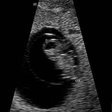 怀孕早期:孕期1-7周胎儿发育全过程,第7周时像