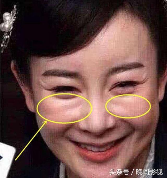 张檬取出假体后遗症严重，变成“风尘女子”！