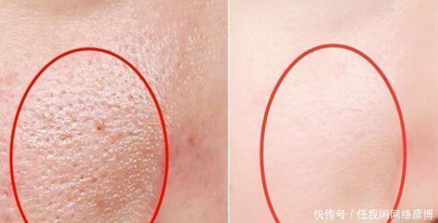 # 黑头#黑头乖乖跑出来，鼻子挤出来的“黄色条物”是啥协和医生教你3招