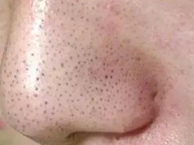 草莓鼻必看！一喷一抹，轻松把黑头分解掉！