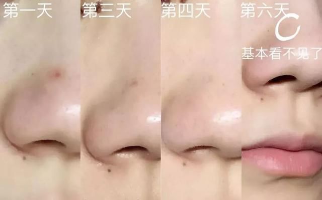 满脸痘怎么见人?用了这个去痘不留印的神器,我把200块的遮瑕都