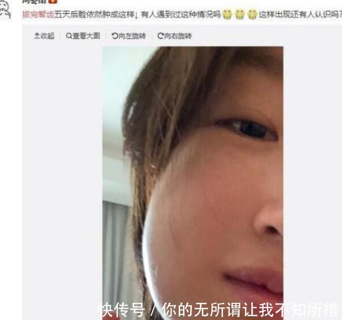 周冬雨拔智齿脸肿