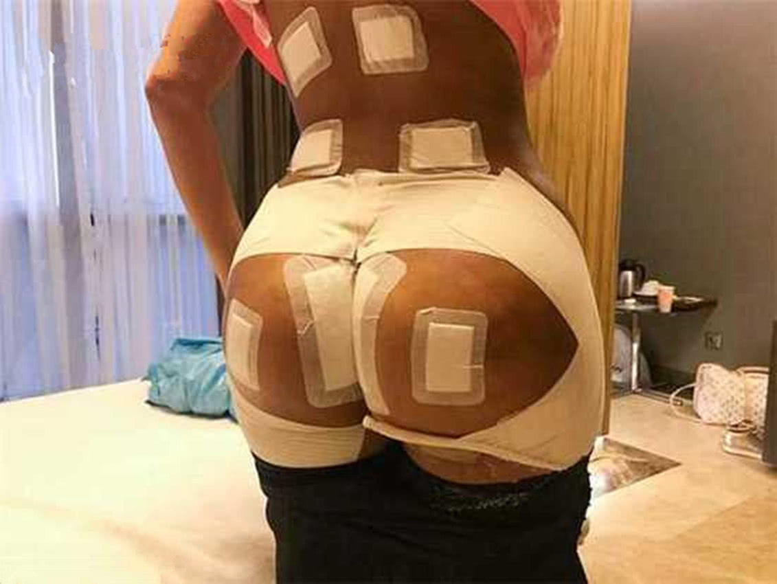 女子花费近14万整容，“只能站不能做”担心填充物会爆炸