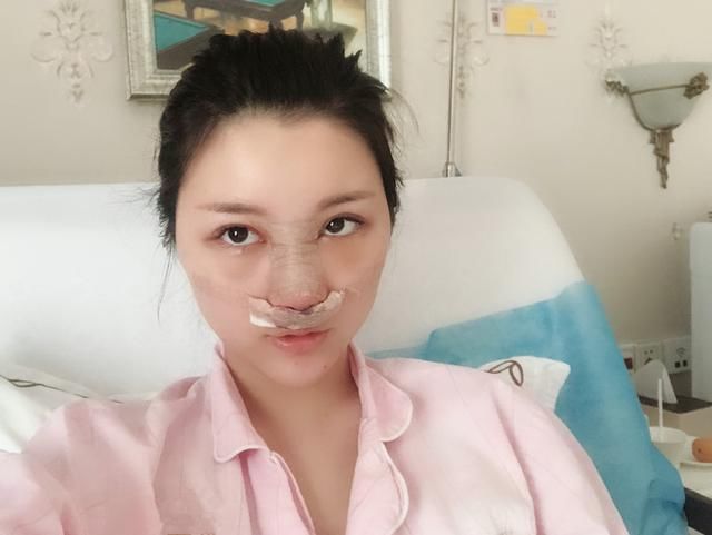 隆鼻后，竟让她成为了羡煞旁人的“明星脸”！