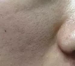 草莓鼻必看！一喷一抹，轻松把黑头分解掉！