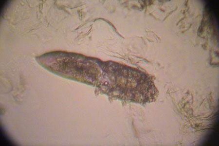 三种现象证明你脸上长螨虫，还这样用醋洗脸，难怪没效果