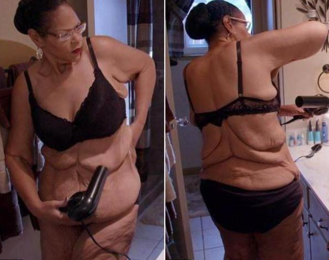 从600多斤到200多斤,减肥成功却留下一身赘皮,洗完澡都会发臭!