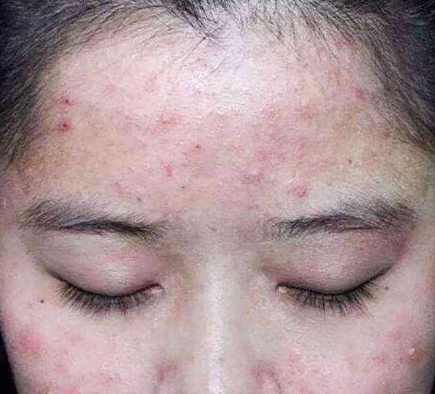 说实话:螨虫超出这个数，4个危害步步紧逼，再不除螨，脸要毁掉