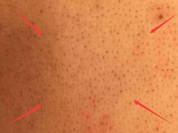 提醒: 后背出现4个征兆, 代表螨虫在“偷吃”, 并发症跟着来