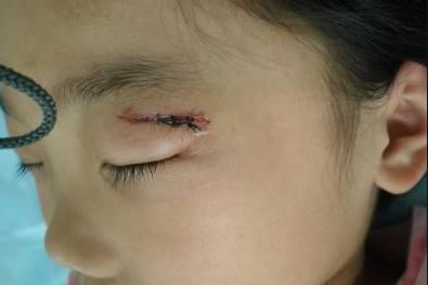  [维生素E]如何去除皮肤疤痕