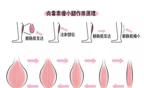  『注射后』有关打针肉毒廋脸瘦小腿的疑难问题，大部分爱美丽人员不清楚！